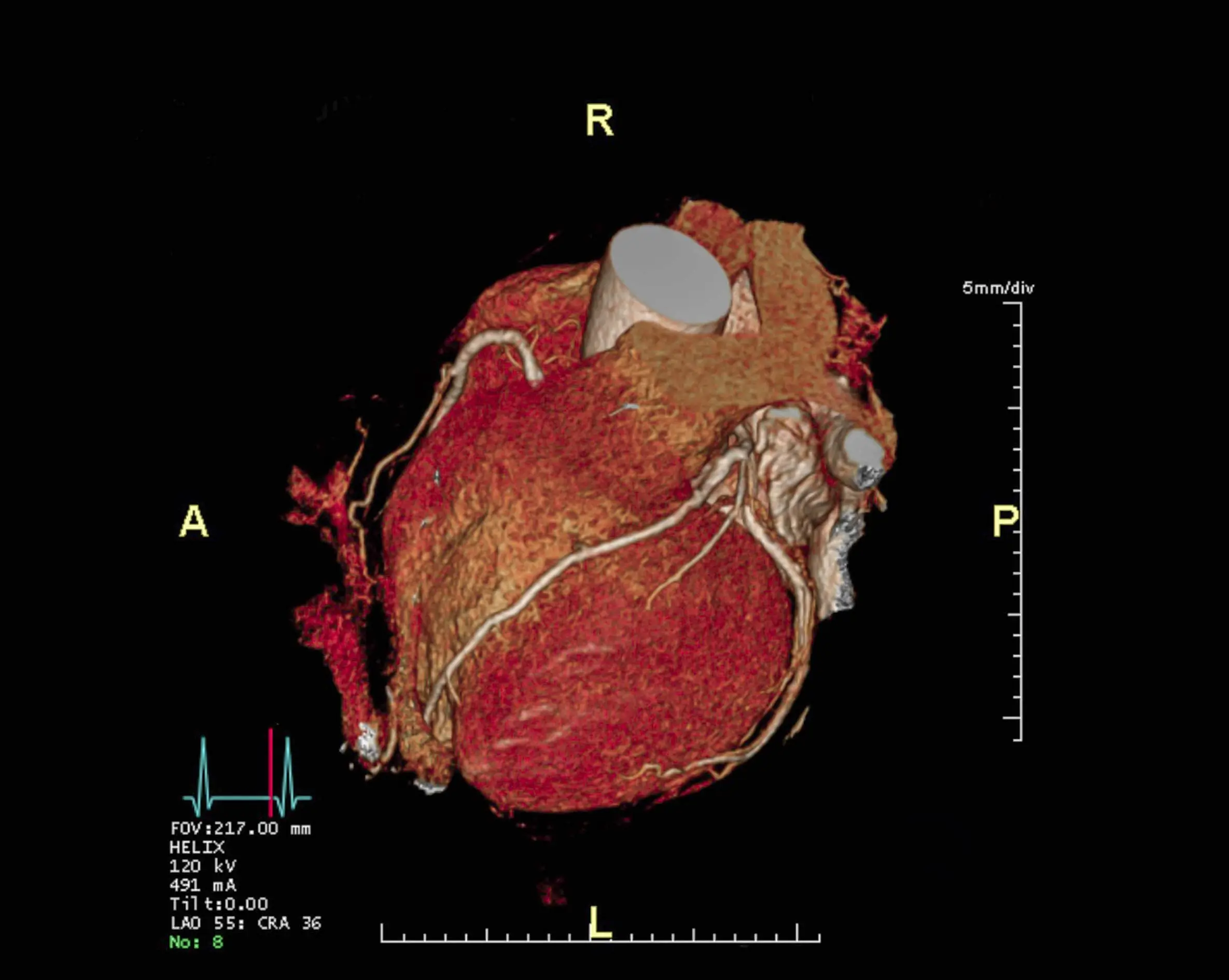 Heart CT image used by cardiologist Dr Francesco Lo Monaco to assess cardiac structure and function