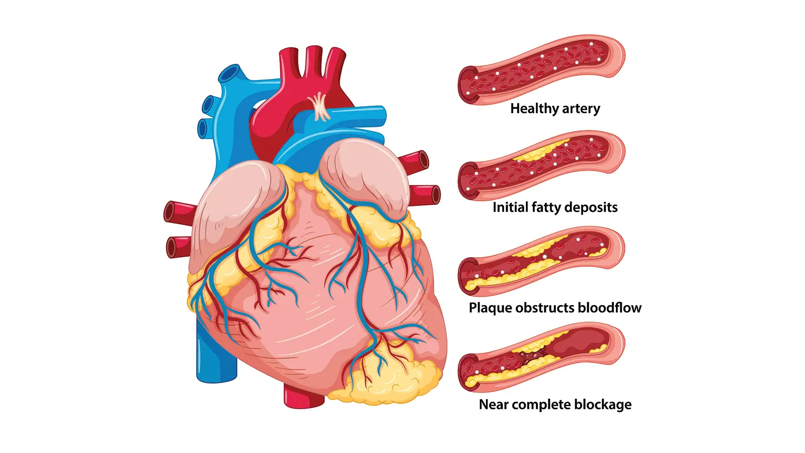 Image of CORONARY ARTERY DISEASE