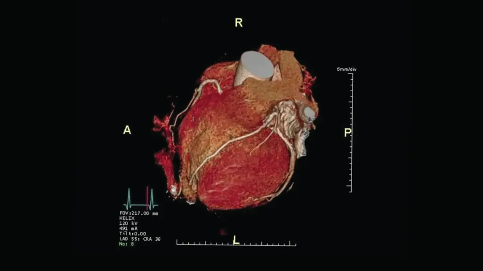 Heart CT image used by cardiologist Dr Francesco Lo Monaco to assess cardiac structure and function