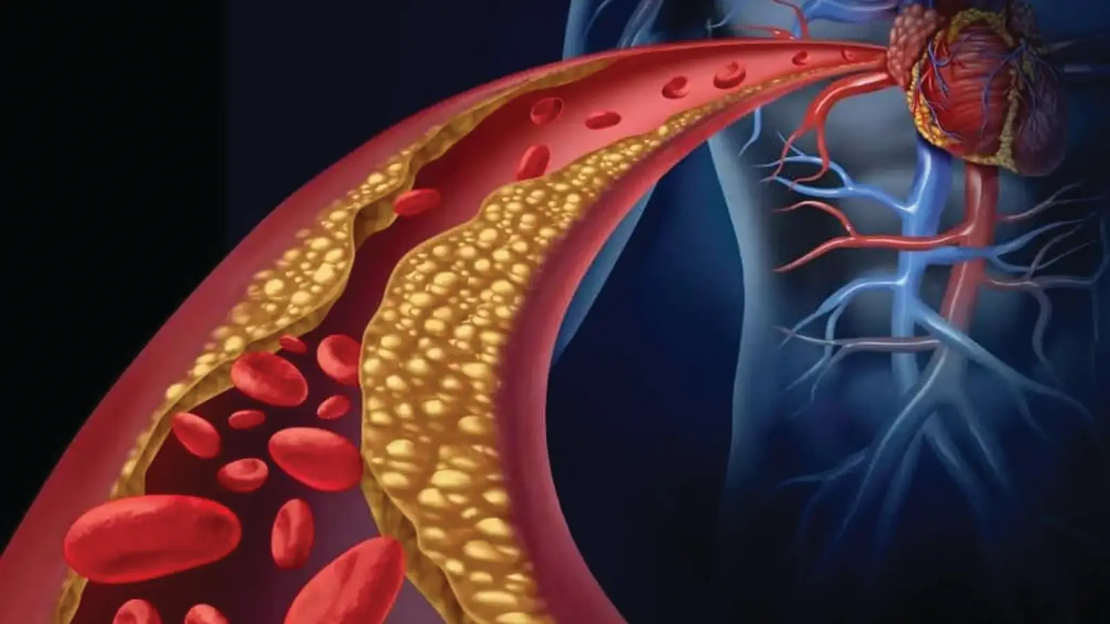 Fatty deposits in arteries due to HIGH CHOLESTEROL.