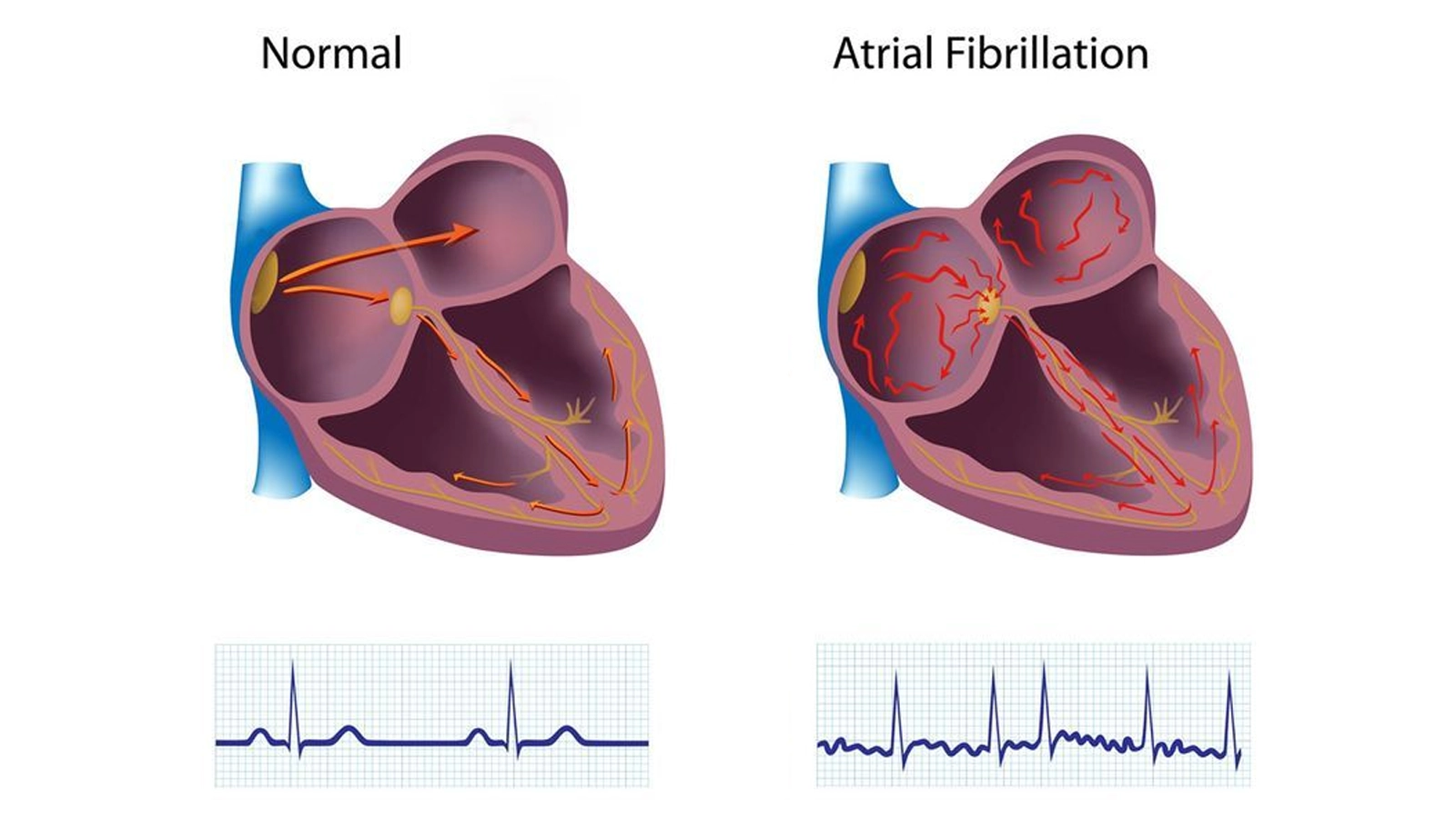 ATRIAL FIBRILLATION (AF)