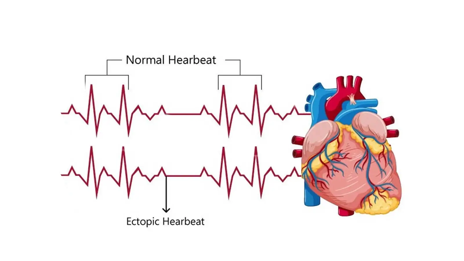 Ectopic heartbeat