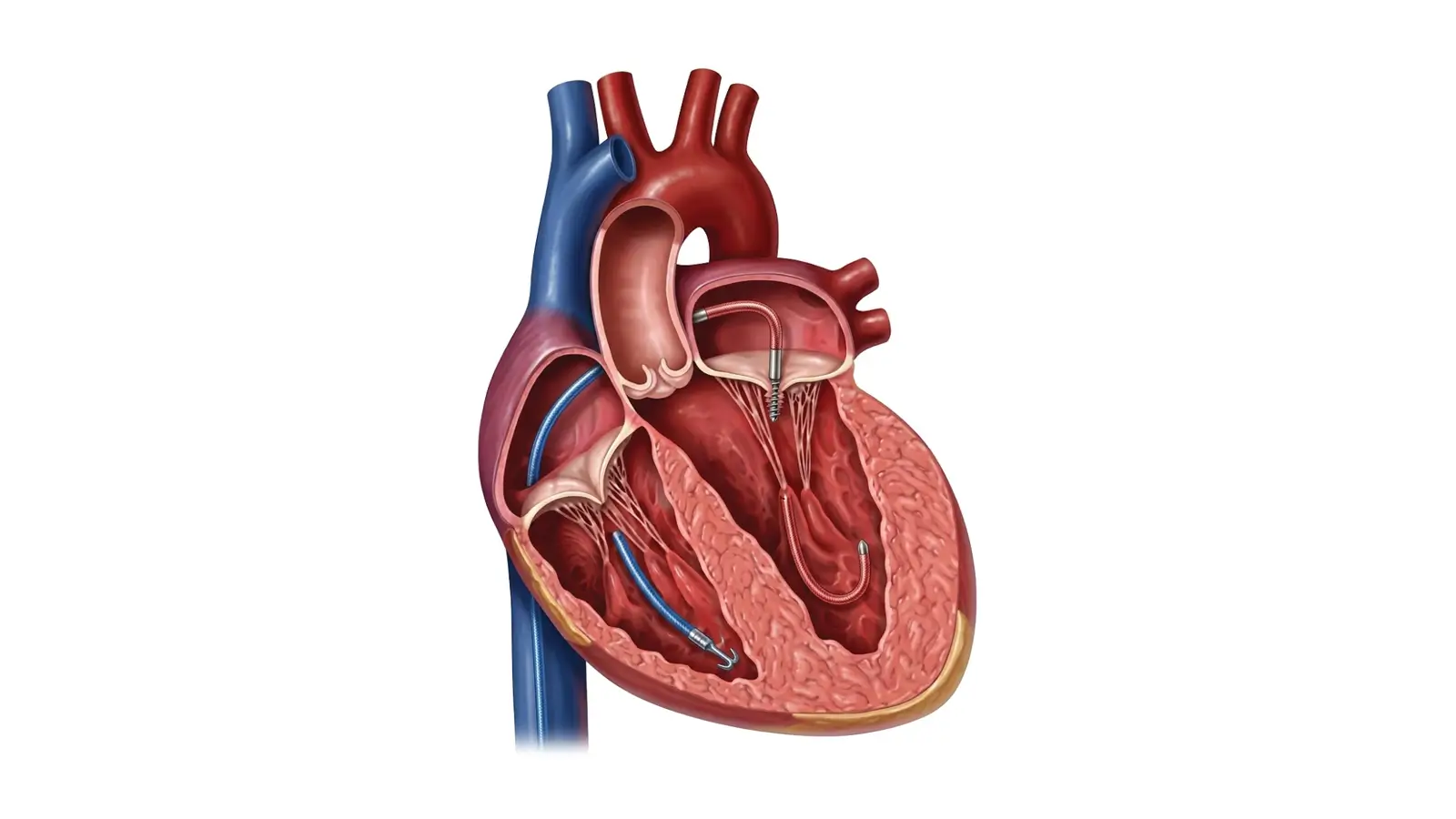 Mitral valve disease