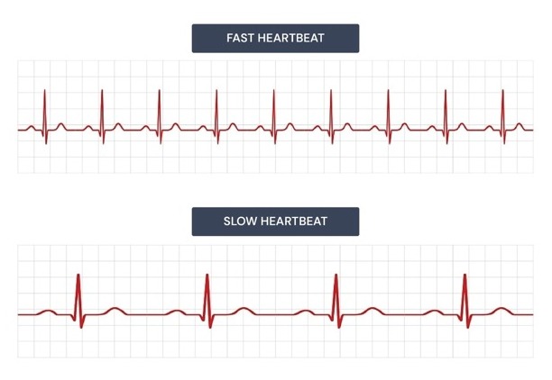 Abnormal ECG Graph