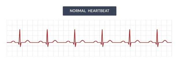 Normal ECG Graph Look Like