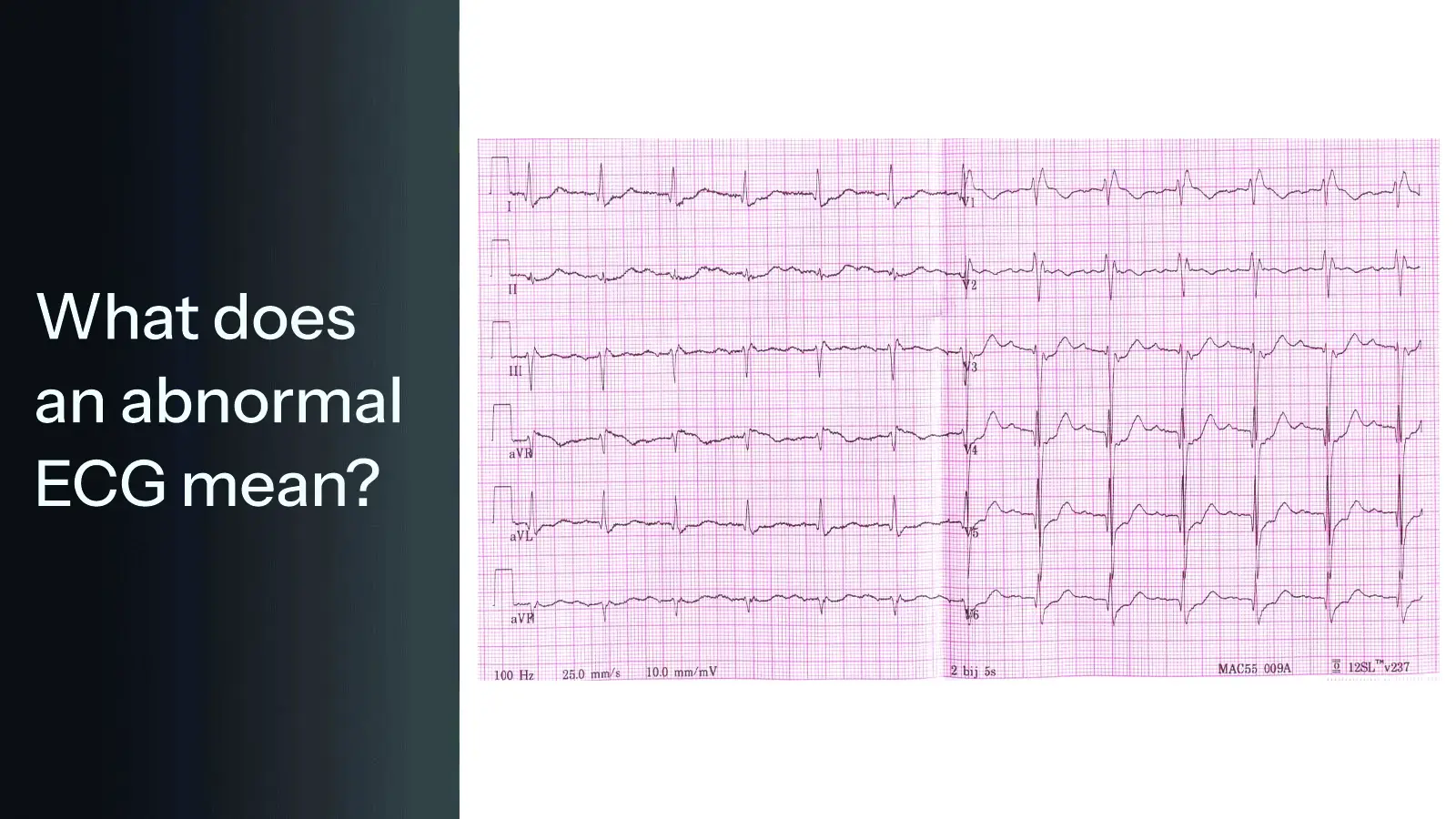 What does an abnormal ECG mean