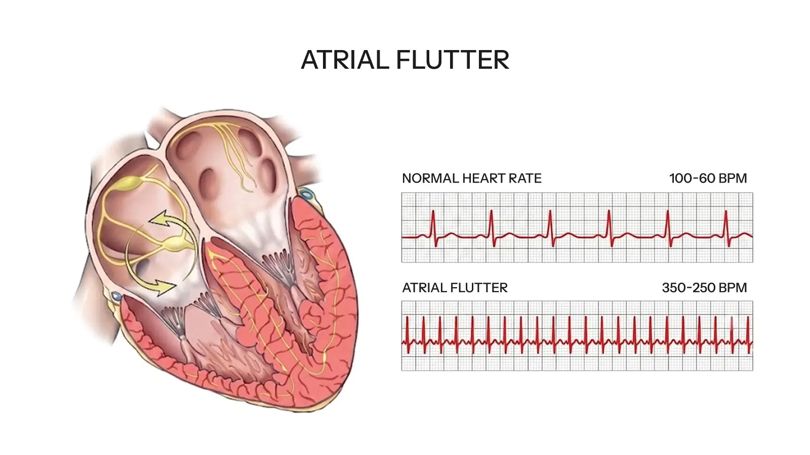 Atrial Flutter FLM
