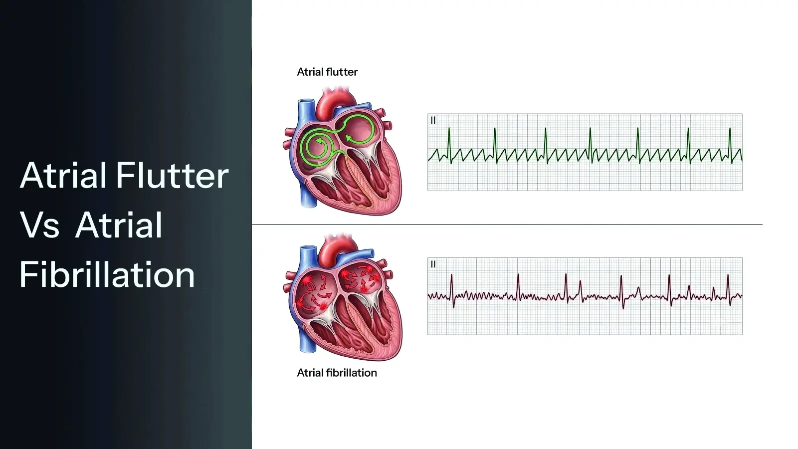 Atrial Flutter Vs Atrial Fibrillation