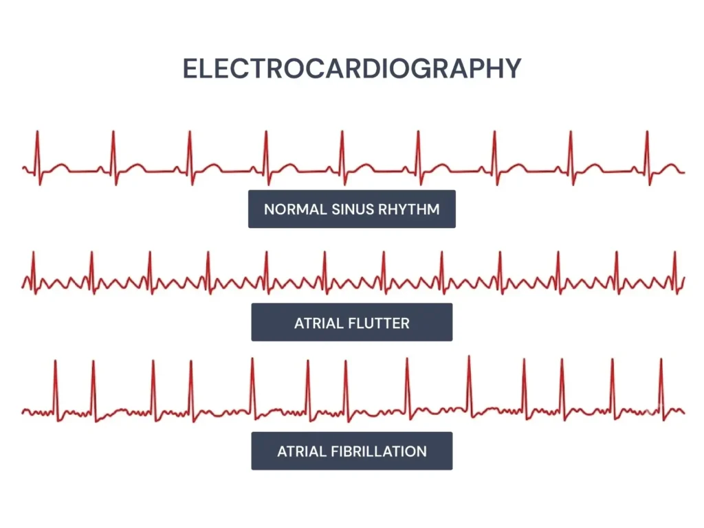 How Atrial Flutter and Atrial Fibrillation ECGs Look
