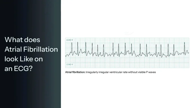 What does Atrial Fibrillation look Like on an ECG