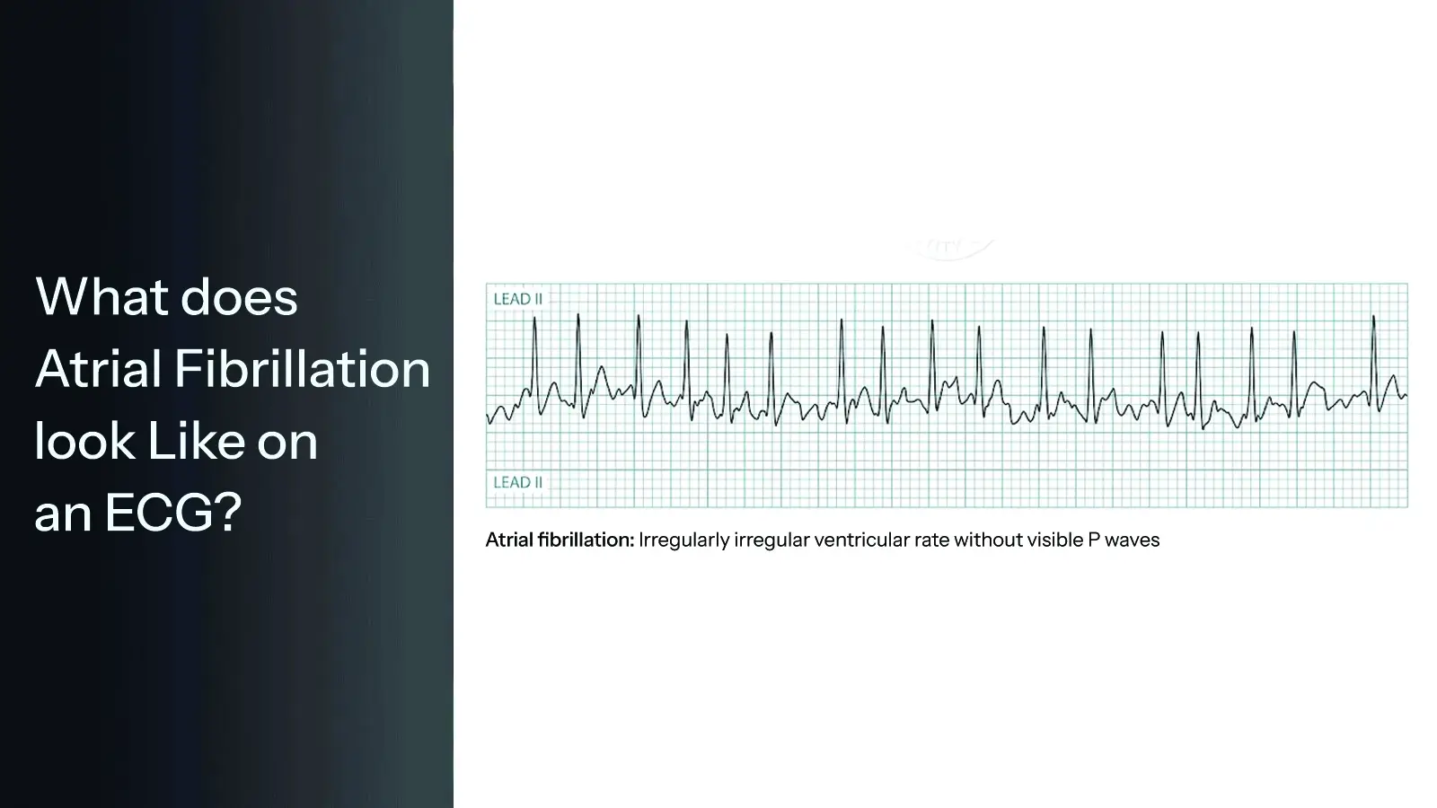 What does Atrial Fibrillation look Like on an ECG