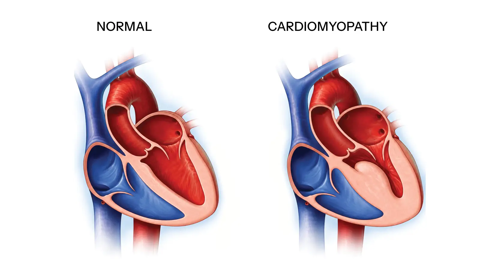 Cardiomyopathy