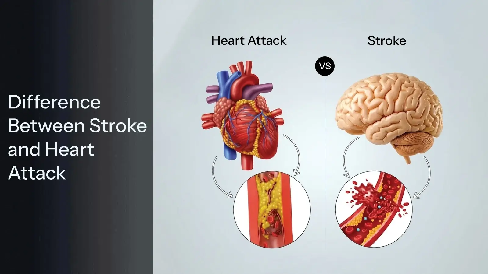 Stroke Vs heart attack