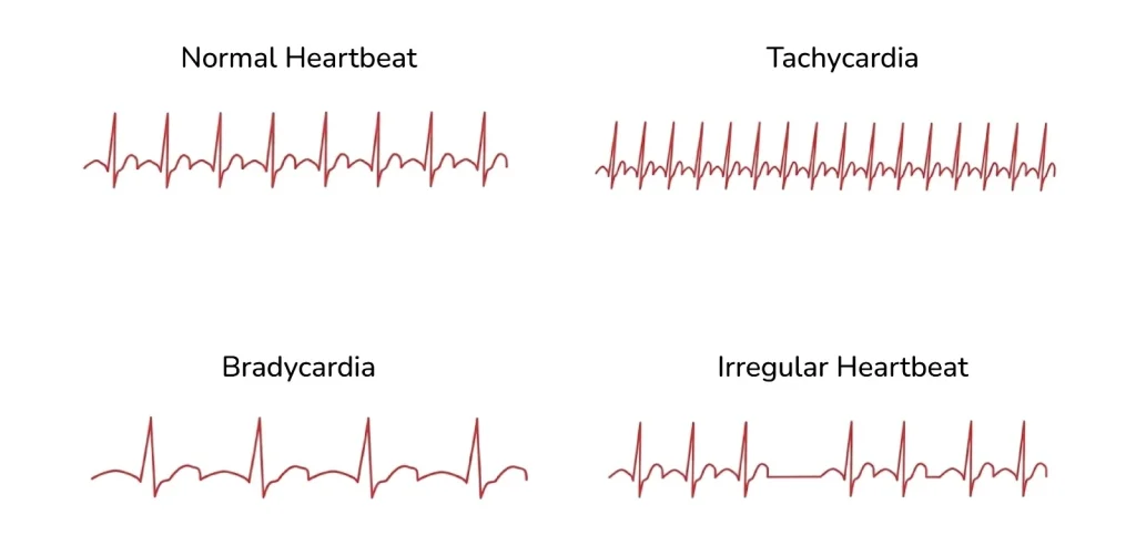 Types of Irregular heartbeats
