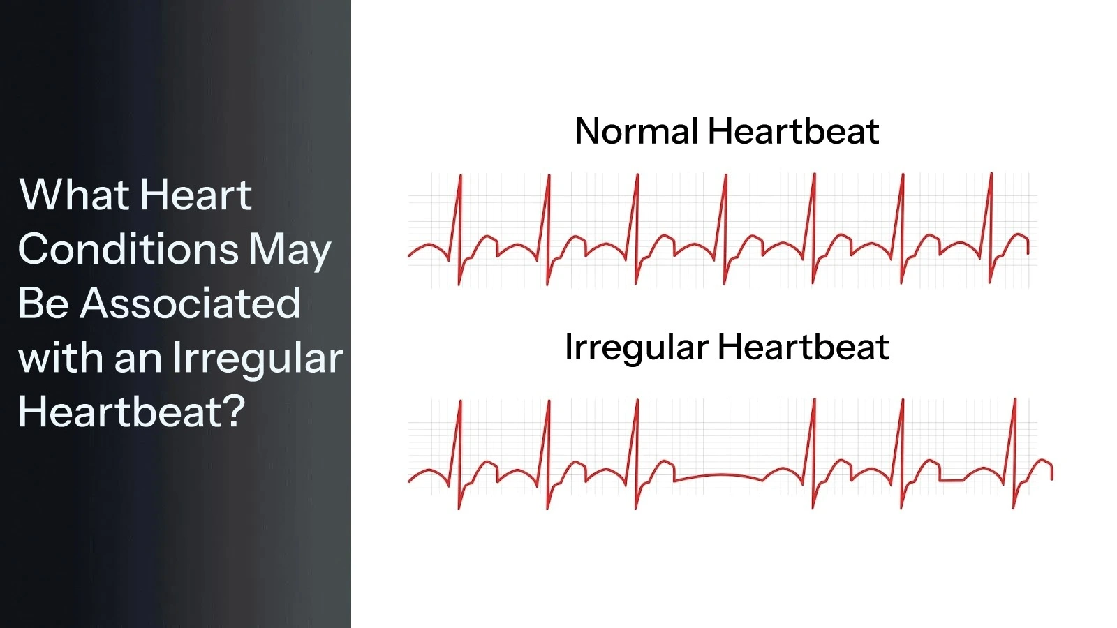 What heart conditions may be associated with irregular heartbeat